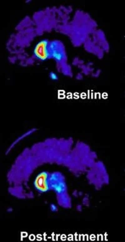 New Growth Factor Indicates Possible Regenerative Effects in Parkinson’s Disease – Neuroscience News