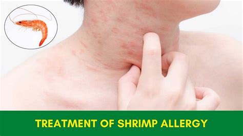 How Do You Treat An Allergic Reaction To Fish: Essential Tips