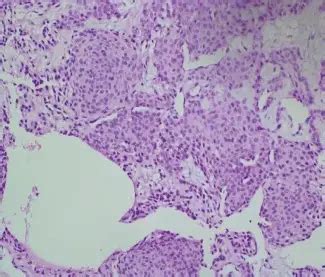 What is a Glomus Tumor? – Pathosomes