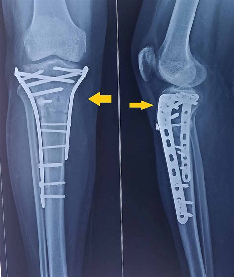 Cureus | Tibial Plateau Fracture with Avulsion Fracture of Tibial Tuberosity: A Case Report and ...