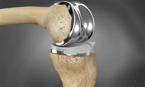 3D Printed Implant Used to Repair Knee Cartilage - Advanced Chiropractic Spine & Sports Medicine