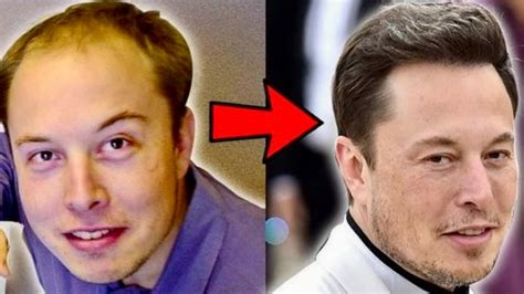 The Journey of Elon Musk Hair Transplant - Before & After