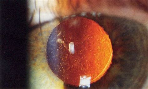 Intraocular lens - wikidoc