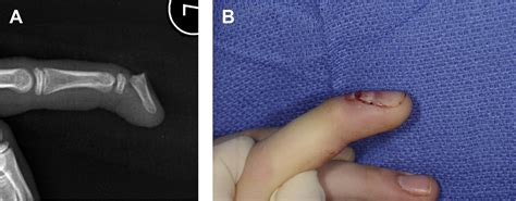 Hand and Wrist Injuries in the Pediatric Athlete - Clinics in Sports ...