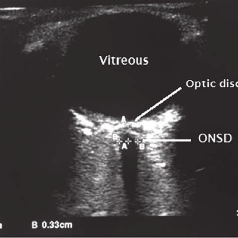 Facial Nerve Ultrasound