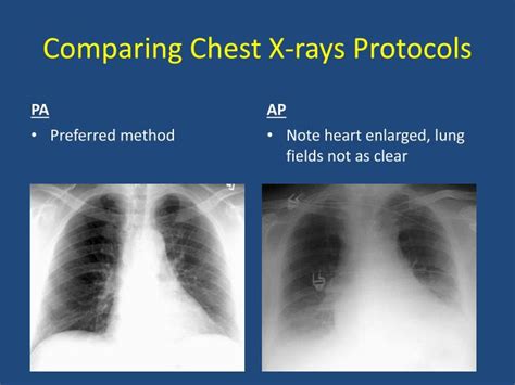 PPT - Basics of Chest X-Ray PowerPoint Presentation - ID:5595574