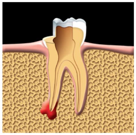 The-damaged-pulp-removed. - Chicopee Park Dental