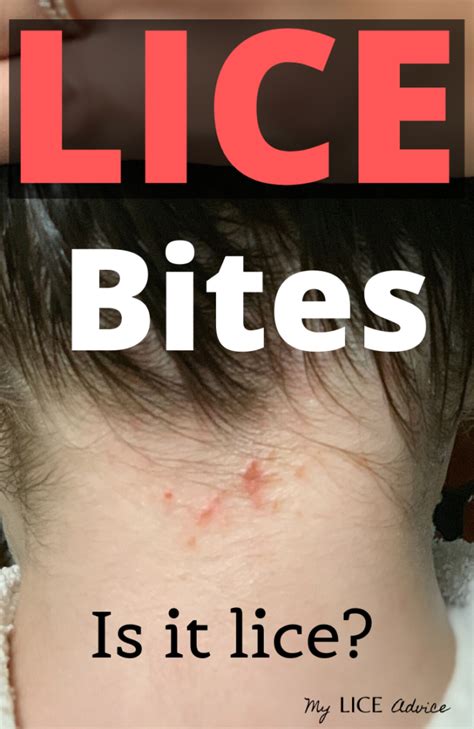 A Closer Look at Lice Bites and Rashes with Pictures - My Lice Advice