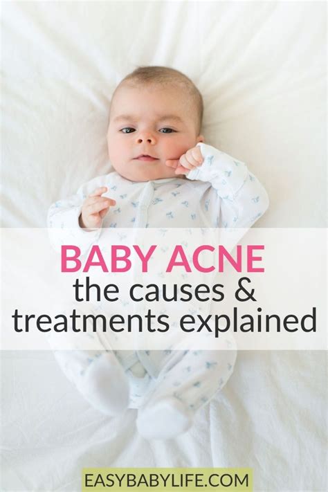 How to Get Rid of Baby Acne: What All Parents Should Know | Baby acne ...