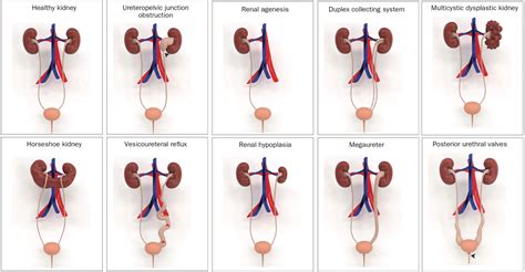 Congenital Anomalies of the Kidney and Urinary Tract | Pediatric Urology Book