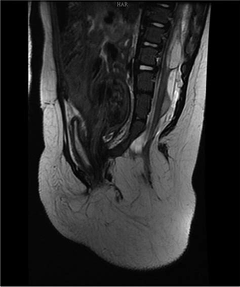 Case 4. Sagittal T2-MRI of the spine showing terminal... | Download Scientific Diagram