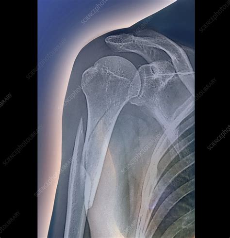 Broken arm, x-ray - Stock Image - C021/2020 - Science Photo Library