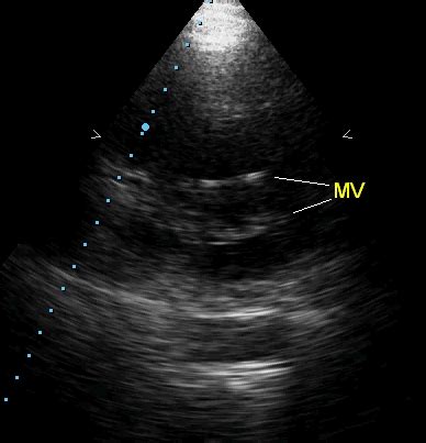 Echocardiographic profile in bioprosthetic mitral valve – All About Cardiovascular System and ...