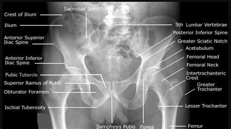 Pelvic Bone Landmarks