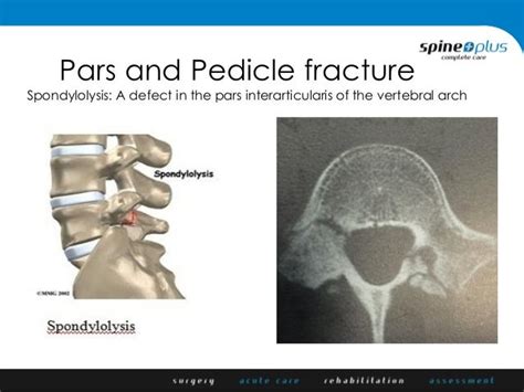 Pars defects and spondylolisthesis