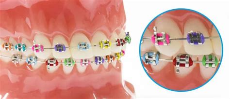 Metal Braces - Standard Fixed Braces for Teeth Straightening