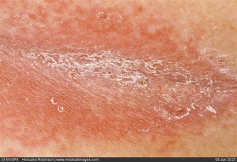 STOCK IMAGE, dermatology psoriasis rash in the gluteal cleft of an elderly man a very red ...