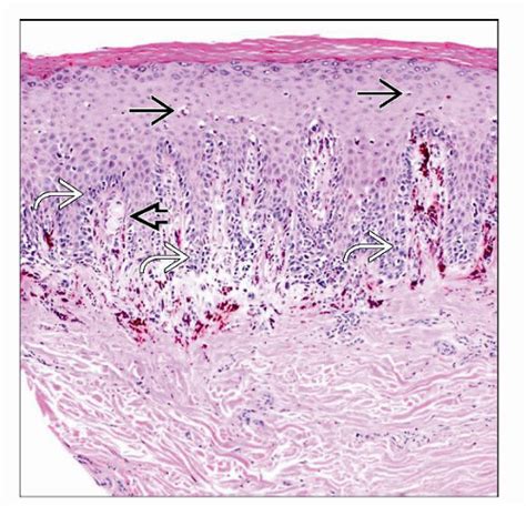 Acral Lentiginous Melanoma | Basicmedical Key