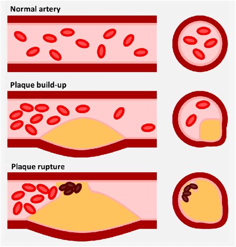 | The atherosclerotic plaque. Illustration depicting the progression of... | Download Scientific ...