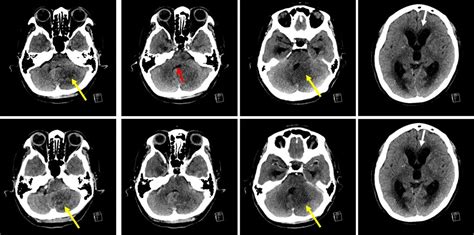 PICA infarction – Radiology Cases