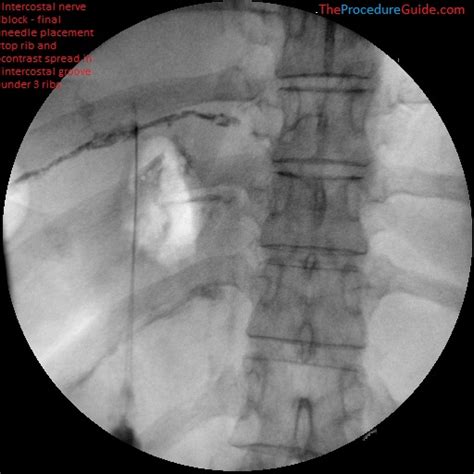 Fluoroscopic Guided Intercostal Nerve Block - Technique and Overview - The Procedure Guide