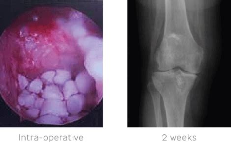 Infected Knee Joint - Biocomposites