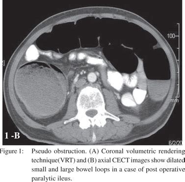 Multi detector computed tomography (MDCT) evaluation of small bowel obstruction: pictorial review