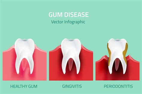 Gum Disease | Signs, Symptoms & Treatment Options