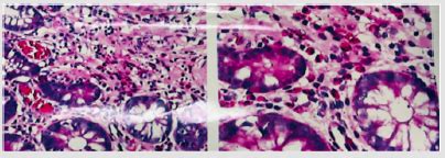 A Rare Case Report of Primary Eosinophilic Colitis