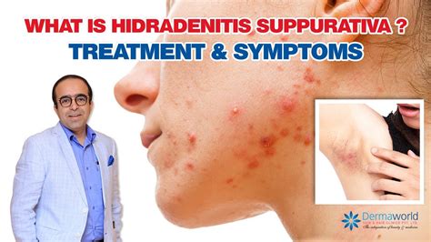 What is Hidradenitis Suppurativa ? ¦ Treatment and Symptoms | Dr Rohit Batra - YouTube