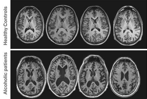 *add new title - MRI scans reveal brain damage from alcohol - Neurotorium