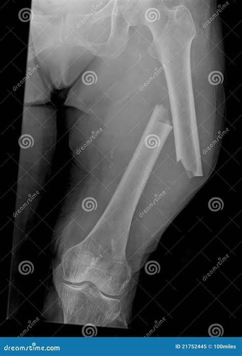 Xray of Broken Femur Bone stock image. Image of doctor - 21752445