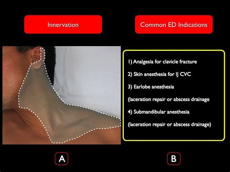 Superficial cervical plexus — Highland EM Ultrasound Fueled pain management