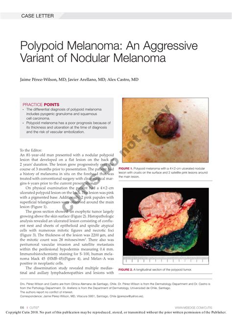 Polypoid Melanoma: an Aggressive Variant of Nodular Melanoma - DocsLib