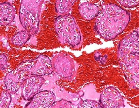 A case of D&E showing extensive perivillous hemorrhage and fibrin... | Download Scientific Diagram