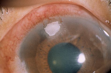 Infectious Keratitis Manifesting as a White Plaque on the Cornea | Cornea | JAMA Ophthalmology ...