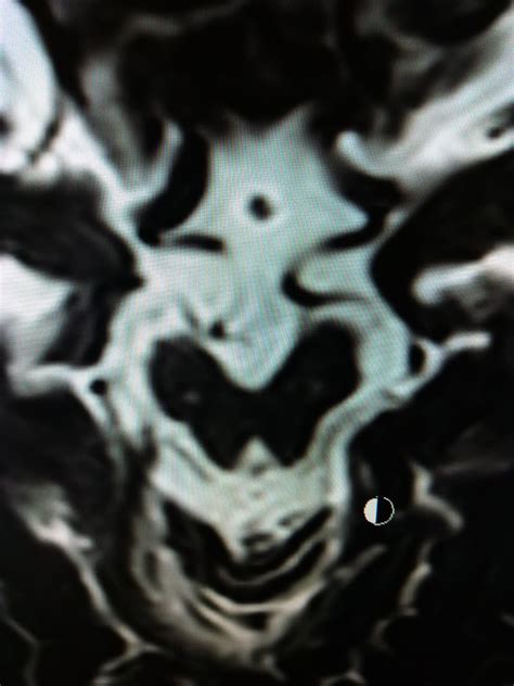 Progressive Supranuclear Palsy: MRI - Sumer's Radiology Blog