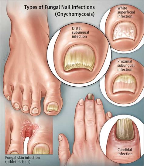 White Superficial Onychomycosis: Types, Symptoms, Causes & Treatment