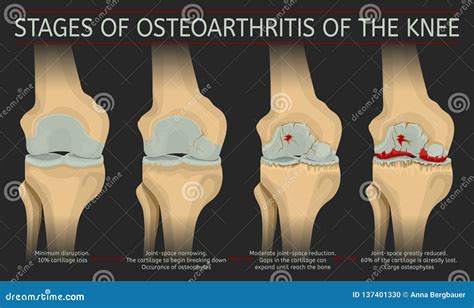 Stages of Osteoarthritis of the Knee Stock Vector - Illustration of ...