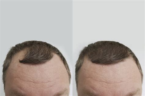 3 Reasons Why Some Men Undergo Multiple Hair Transplants