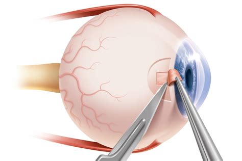 Glaucoma Surgery Cost In India