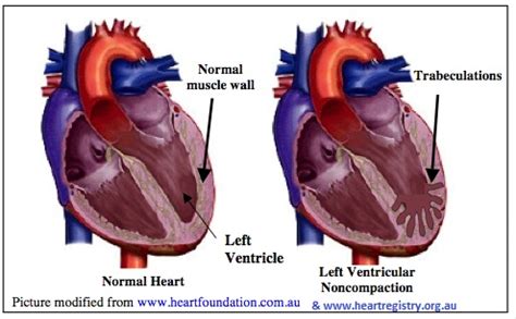 Left Ventricular Non-Compaction Cardiomyopathy – CIDG