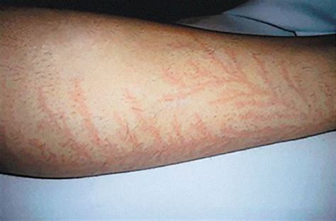 18 Lightning Strike Survivors Reveal Their Shocking Markings