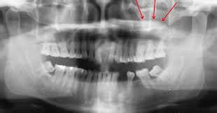 Types and Treatments of Mucous Retention Cysts | New Health Advisor