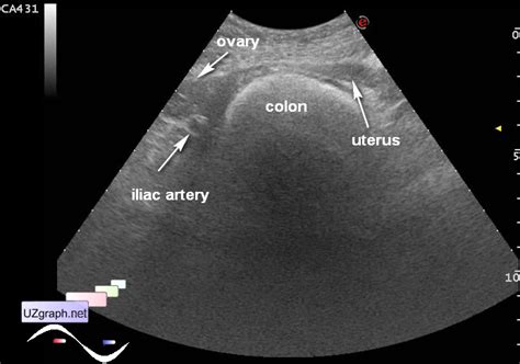 Gastrointestinal sonography - Hirschsprungs disease - Clinical report, Video, Images :: Forum of ...