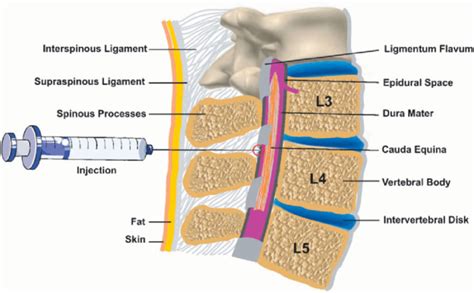 Epidural and Combined Spinal-Epidural: Pharmacology, Technique, and Side Effects - OpenAnesthesia