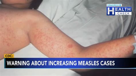 Measles outbreak 2024: CDC warns health care workers to be on alert amid rising number of cases ...