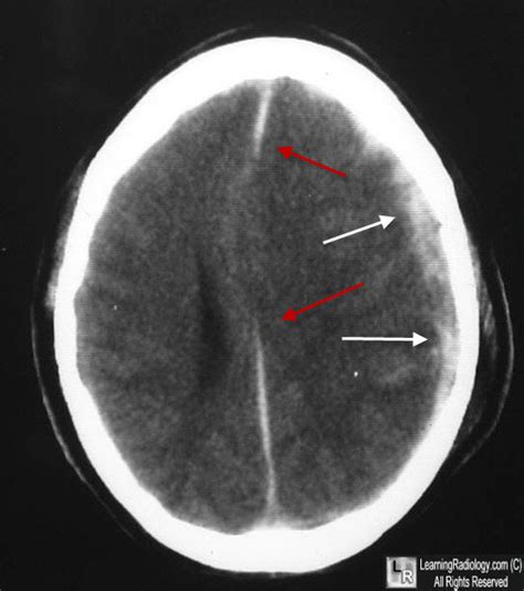 Subdural Hematoma CT Scan