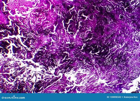 Histopathology Of Silicosis, Light Micrograph Stock Image ...