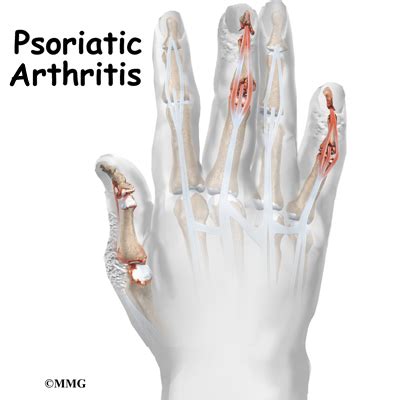 Psoriatic Arthritis - eOrthopod.com